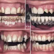 门牙换牙的平均时间是多少?